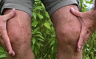Best tips to follow for fast recovery after Knee Replacement Surgery